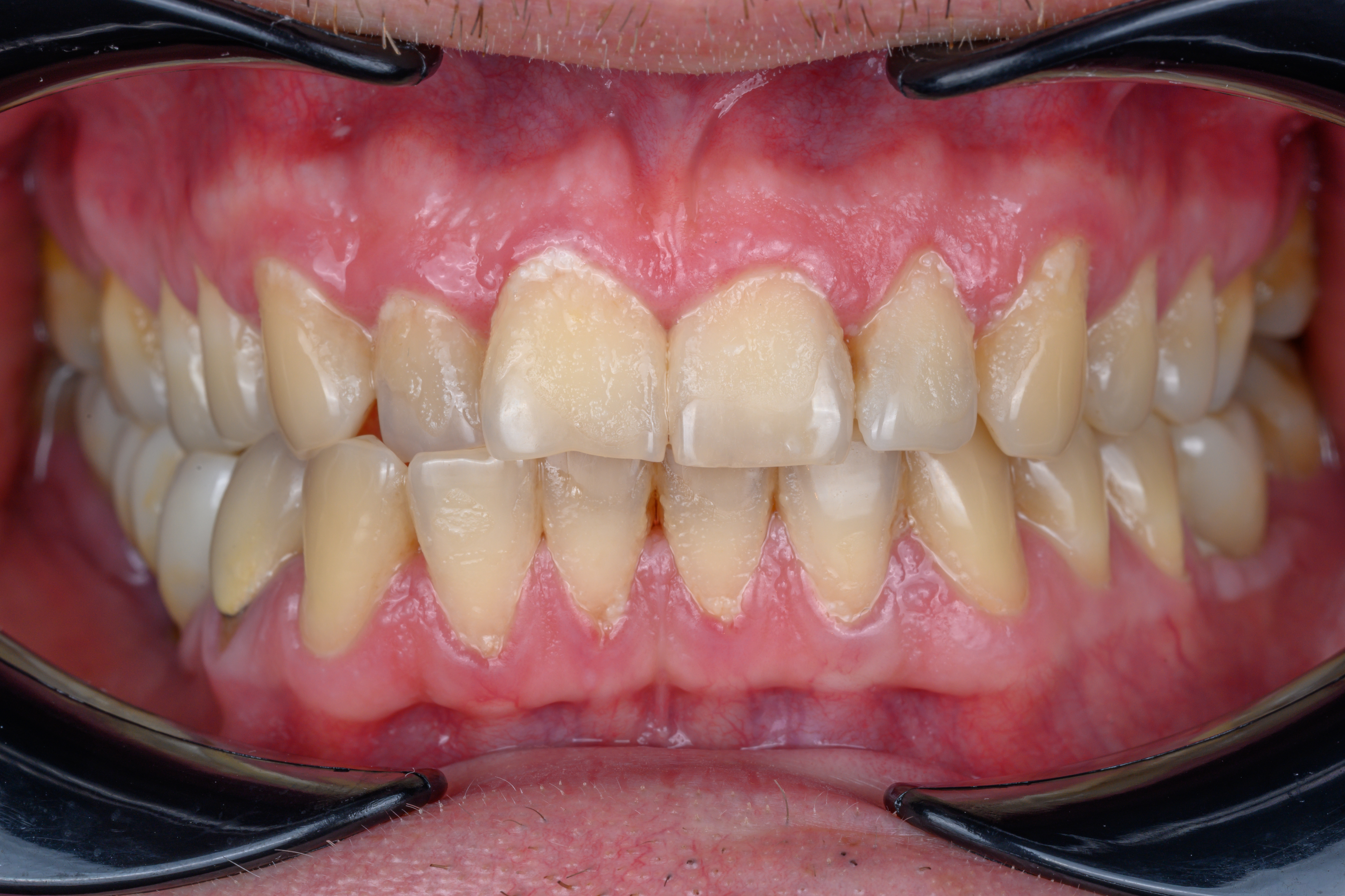 GBT before treatment showing plaque buildup and staining on teeth