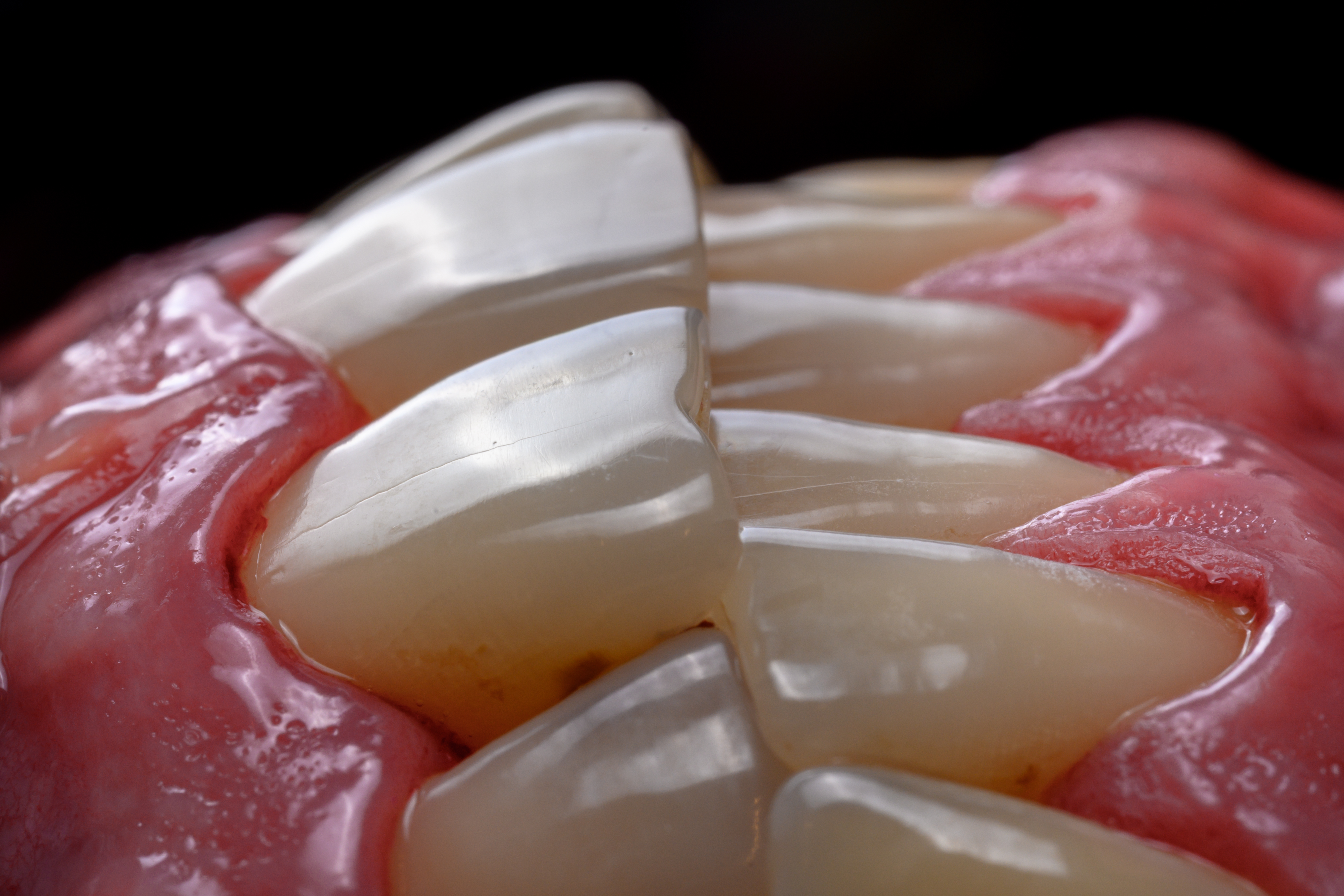 Clean teeth after GBT treatment showing remarkable improvement